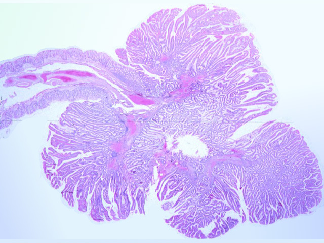 Pathology Outlines - Tubular adenoma